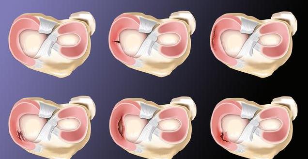 img, 月板坏了, 大部分人这